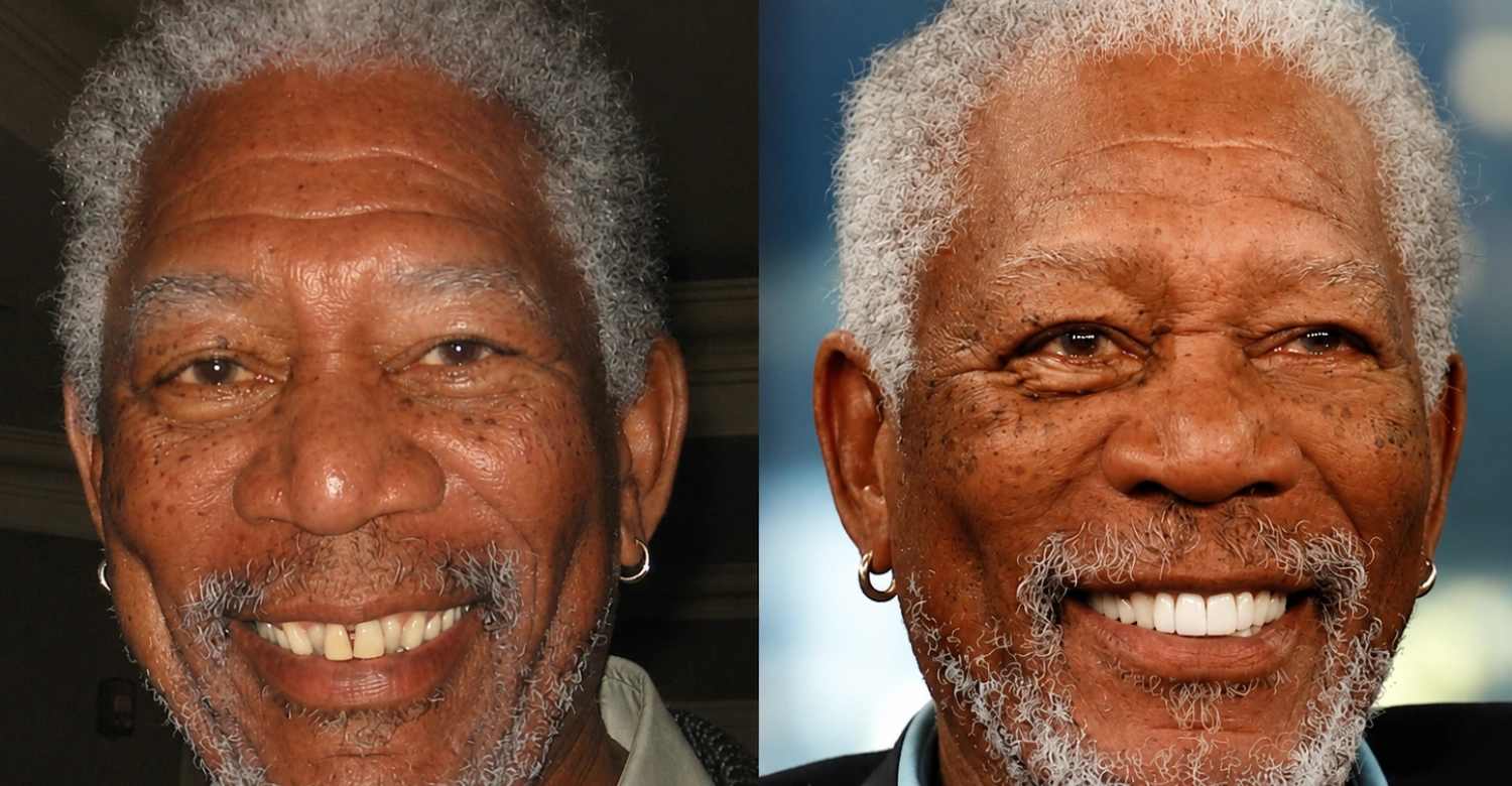 Celebrity Dental Implants Before and After4 (2)